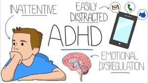 NIOS for ADHD Students